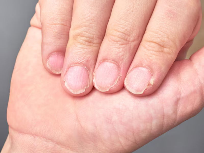 Remoção inadequada de unhas em gel, causando danos.